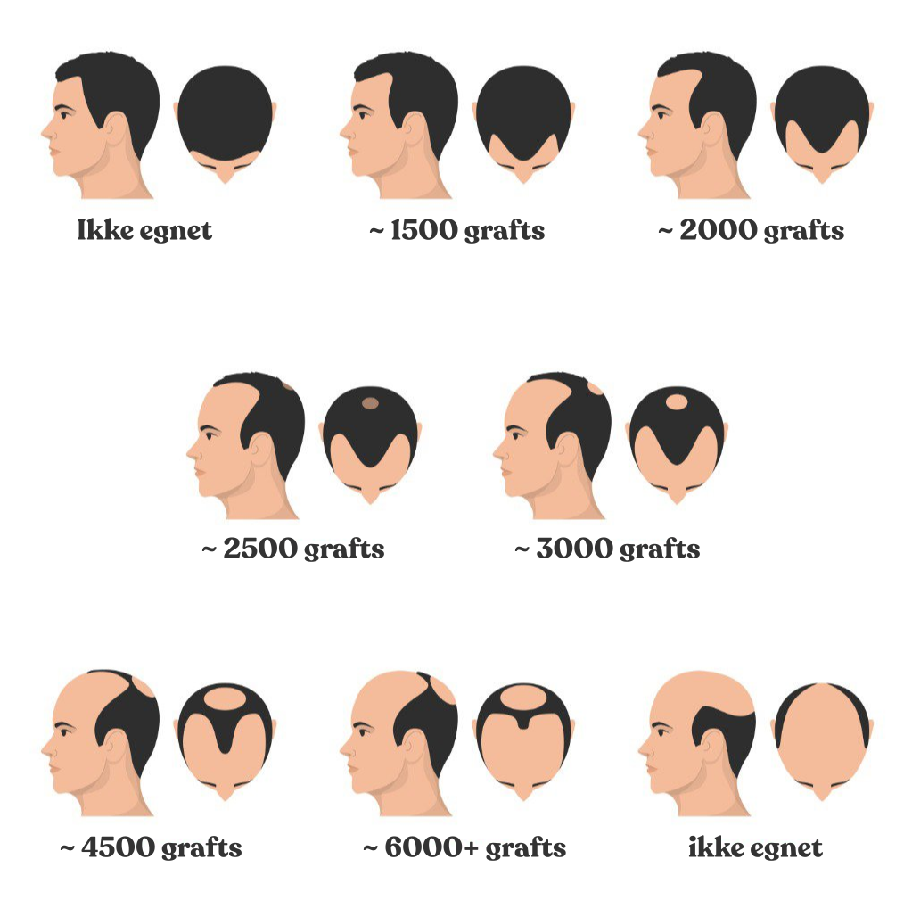 Antal Grafts